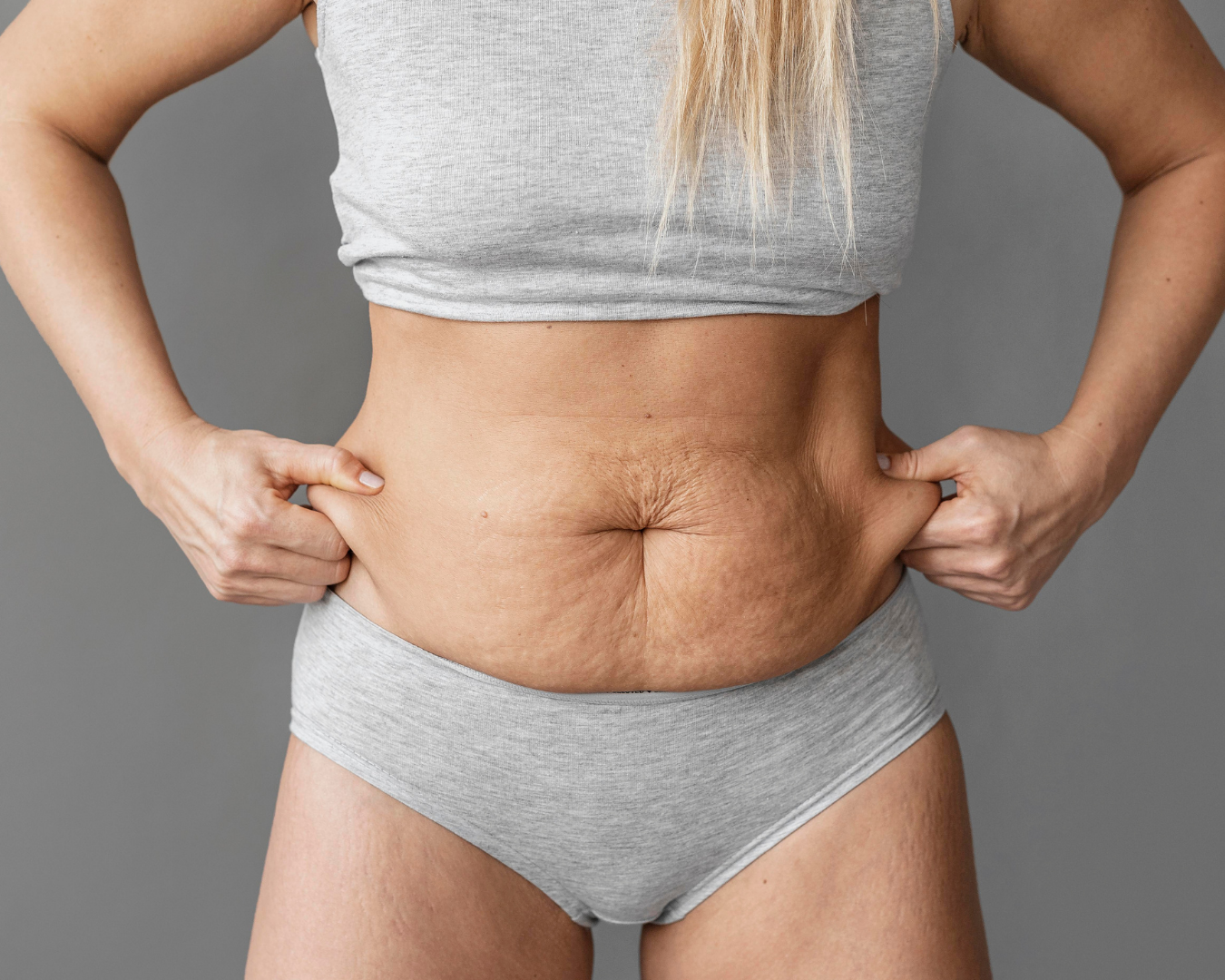 Abdominoplastia